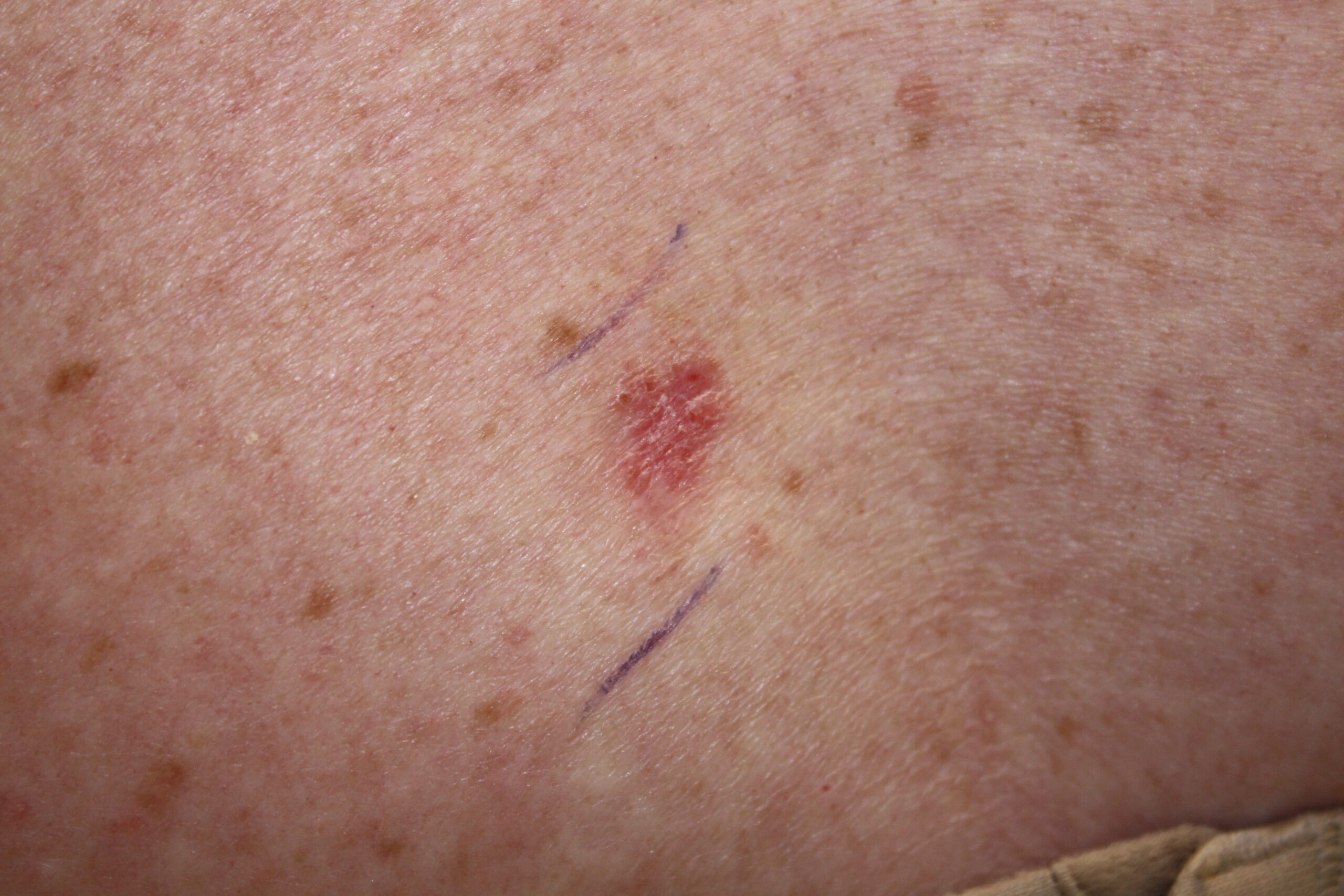 BCC (Bazal Hücreli Karsinom)