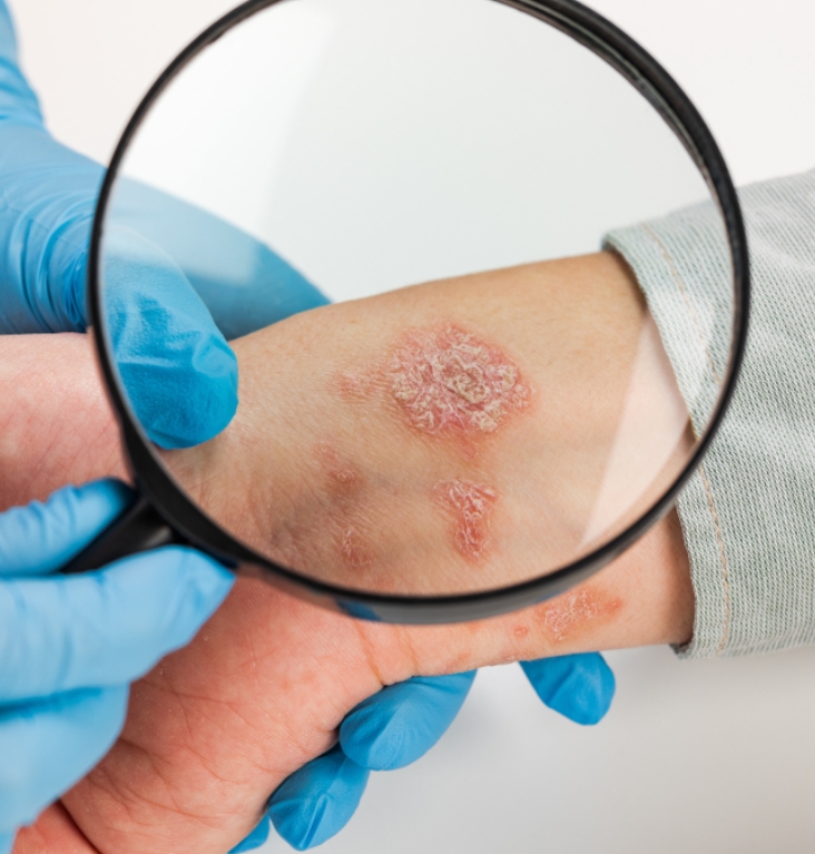 Cilt Kanseri Tedavisi İzmir